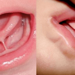 Tongue and Lip Release